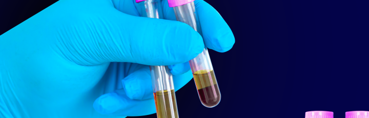 From Plasma to Pathology: A Robust Workflow for EV Isolation and Quantification