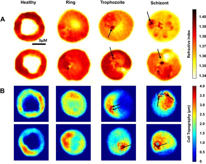 Three-dimensional refractive index and phase map of P. knowlesi-infected RBCs.