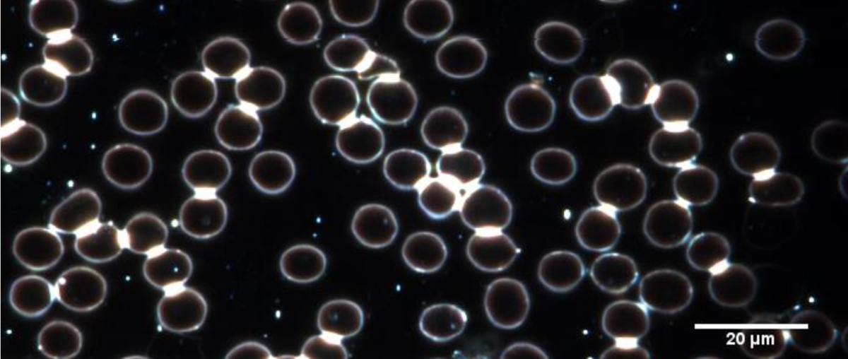 Whole blood sample from subject experiencing viral infection symptoms. Note, bluish viral particles present throughout the image